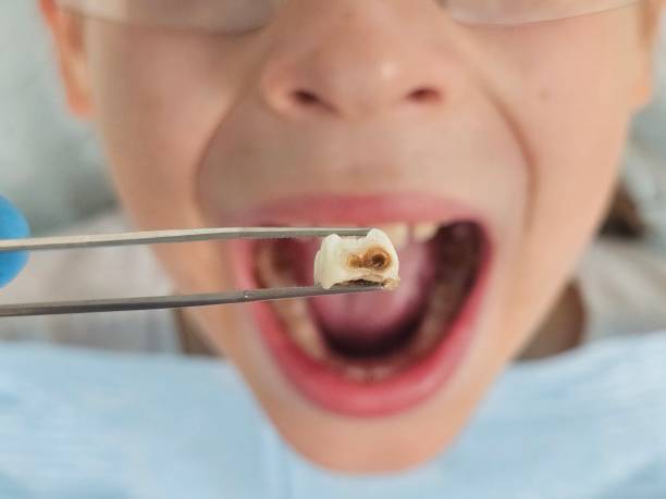 Best Emergency Dentist for Lost Fillings or Crowns in Blackwood, NJ